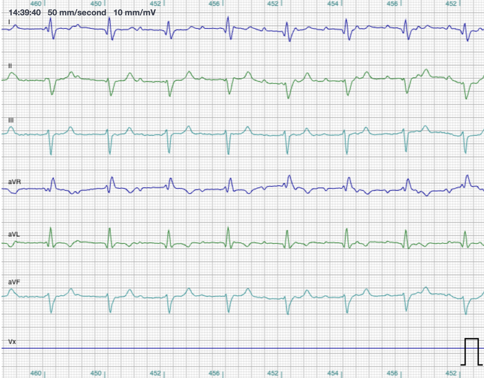 Six-lead ECG from Smokey recorded at 50 mm per second, showing regular QRS complexes and faster, completely dissociated P waves marching through the trace