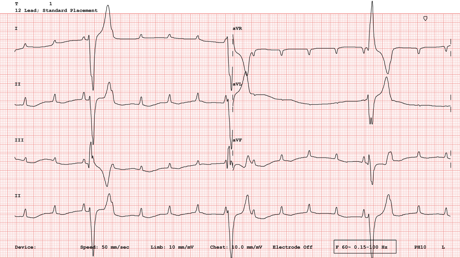 Twelve-lead ECG from a dog with third-degree AV block, showing wide QRS complexes from a ventricular escape focus and dissociated P waves marching through