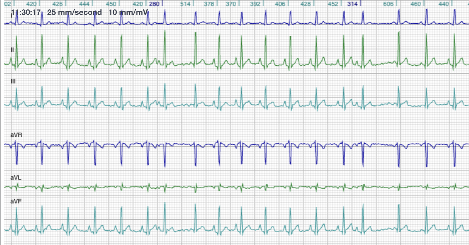 Six-lead ECG from Molly showing sinus rhythm interrupted by occasional premature complexes, recorded at 25 mm per second and 10 mm per millivolt