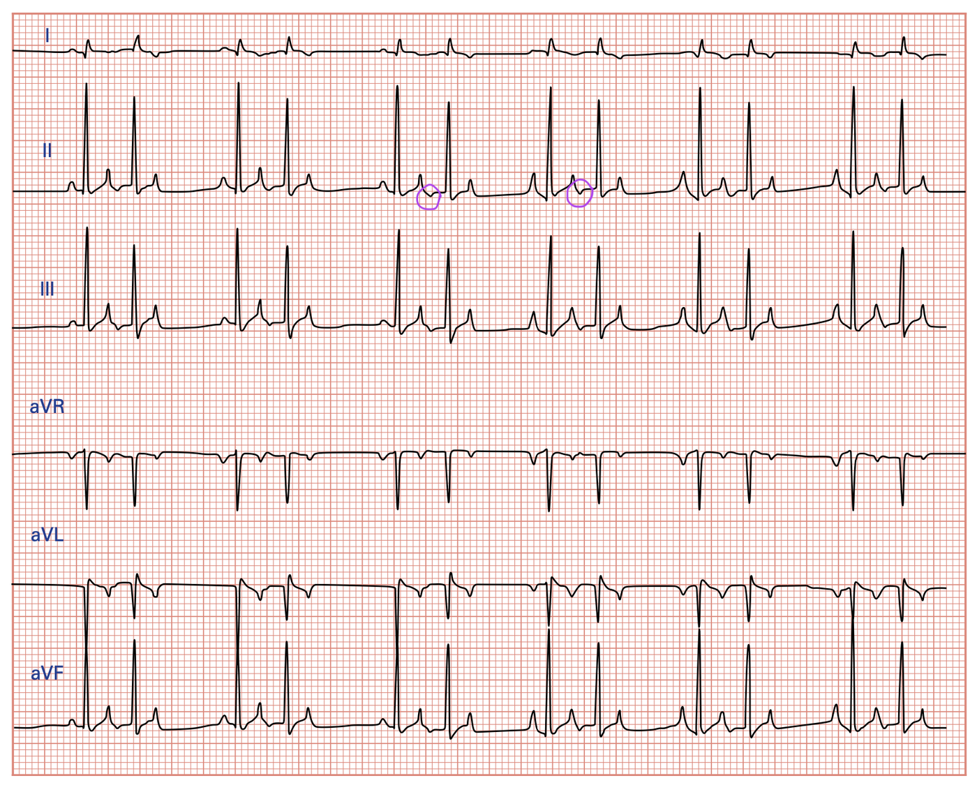 Six-lead ECG showing atrial bigeminy, with sinus beats and atrial premature beats alternating one to one, and small negative ectopic P prime waves circled in purple