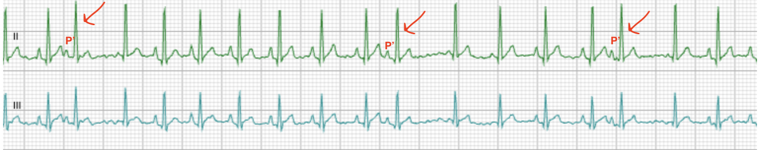 Leads II and III with three premature atrial complexes marked, each preceded by a red arrow and a labelled ectopic P prime wave