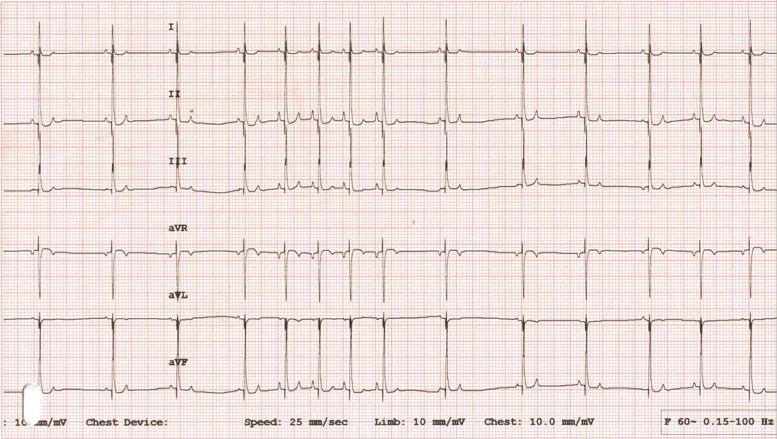 Six-lead ECG from Beansie recorded at 25 mm per second, showing cyclical variation in the R to R intervals with respiration, a P wave before every QRS complex, and P waves that vary in height across the respiratory cycle